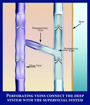 varicose vein pictures #10